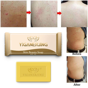 7g Sulfur Soap Acne Soap Oil-control Acne Treatment Whitening Cleanser Moisturizing Removal Pimple Pore Fungus Soap Anti-mite